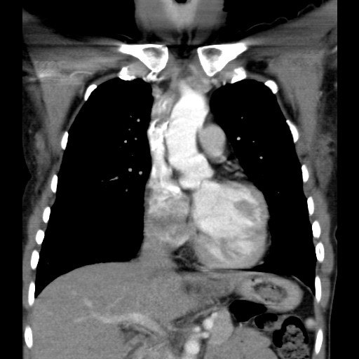 File:Non-small cell lung cancer with miliary metastases (Radiopaedia 23995-24193 B 8).jpg