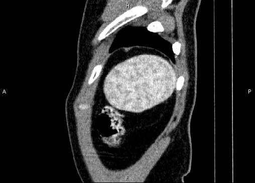 Non-syndromic pancreatic endocrine tumor (Radiopaedia 86958-103178 E 96).jpg