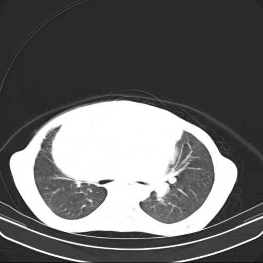 File:Non hodgkin lymphoma of the mediastinum (Radiopaedia 20814-20729 Axial lung window 23).jpg