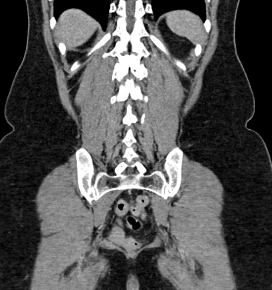 Normal CT intravenous urogram (Radiopaedia 39444-41759 A 351).jpg