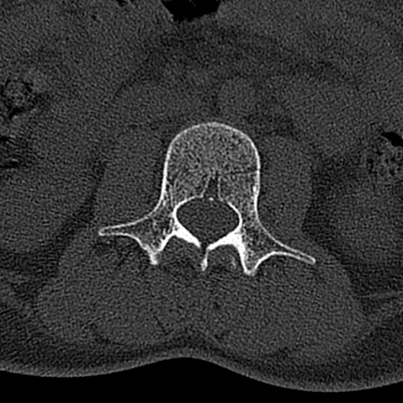 File:Normal CT lumbar spine (Radiopaedia 53981-60118 Axial bone window 34).jpg