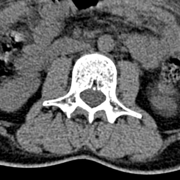Normal CT lumbar spine (Radiopaedia 53981-60118 Axial non-contrast 47).jpg