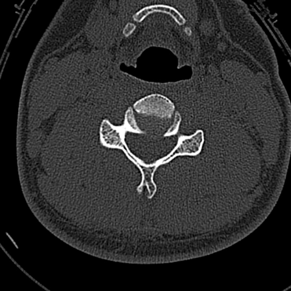 File:Normal CT of the cervical spine (Radiopaedia 53322-59305 Axial bone window 147).jpg