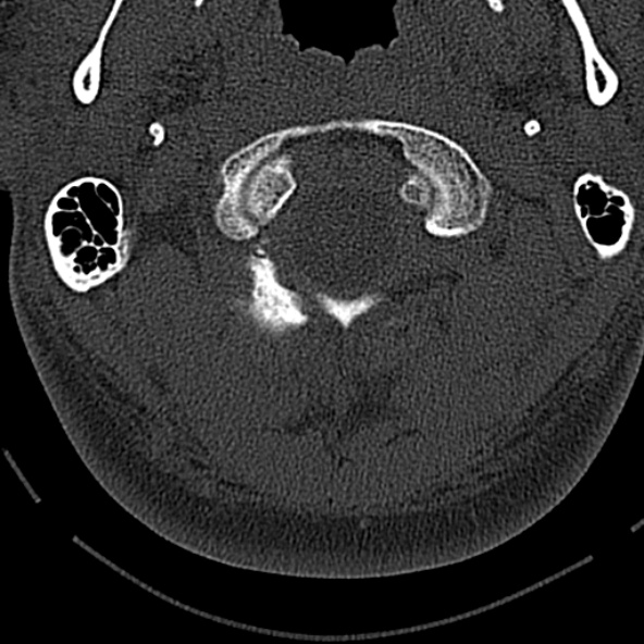 Normal CT of the cervical spine (Radiopaedia 53322-59305 Axial bone window 48).jpg