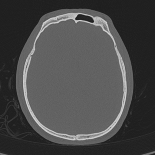 Normal CT skull (Radiopaedia 40798-43459 A 90).png