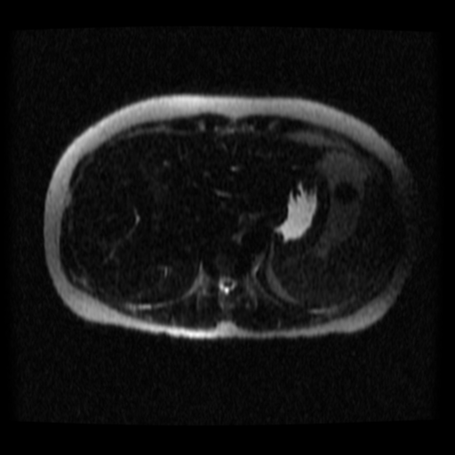 File:Normal MRCP (Radiopaedia 41966-44978 Axial T2 thins 29).png