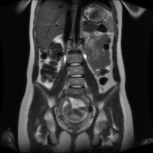 File:Normal MRI abdomen in pregnancy (Radiopaedia 88001-104541 Coronal T2 19).jpg