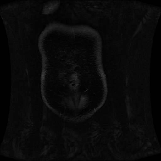 Normal MRI abdomen in pregnancy (Radiopaedia 88001-104541 M 20).jpg