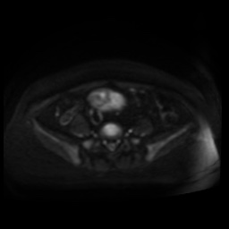 Normal MRI abdomen in pregnancy (Radiopaedia 88005-104548 Axial DWI 66).jpg