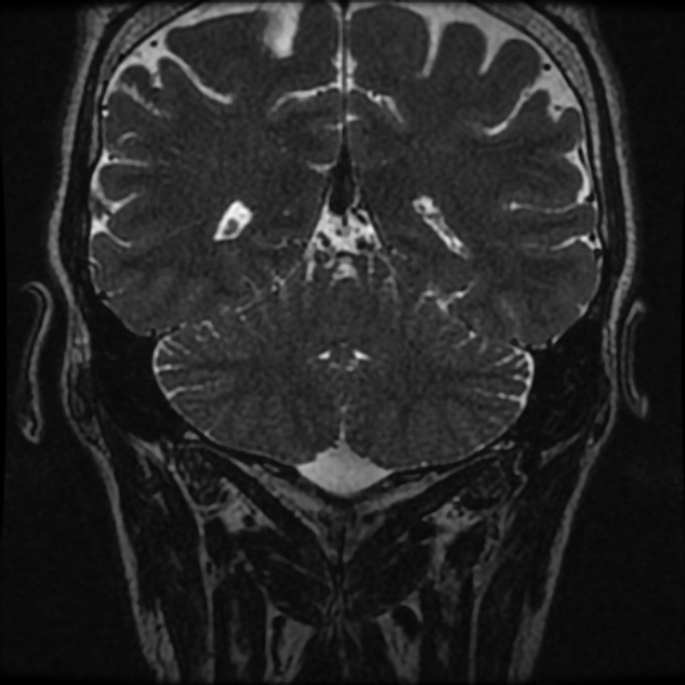 Normal MRI petrous (Radiopaedia 91317-108949 Coronal T2 100).jpg