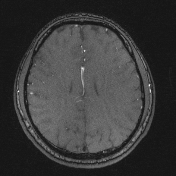 Normal brain MRI including MRA (Radiopaedia 48748-53763 Axial MRA 147).jpg