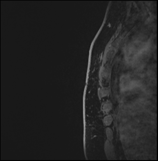 Normal breast MRI - dense breasts (Radiopaedia 80454-93850 I 177).jpg
