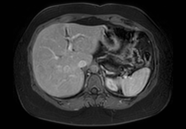 Normal liver MRI with Gadolinium (Radiopaedia 58913-66163 J 51).jpg