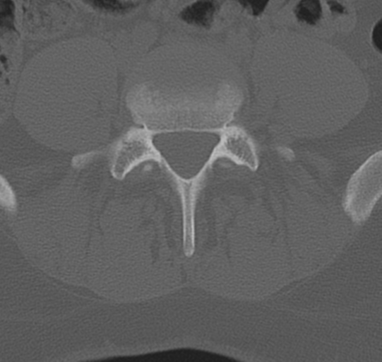 File:Normal lumbar spine CT (Radiopaedia 46533-50986 Axial bone window 56).png