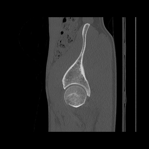Normal pelvis (Radiopaedia 51473-57238 Sagittal bone window 33).jpg