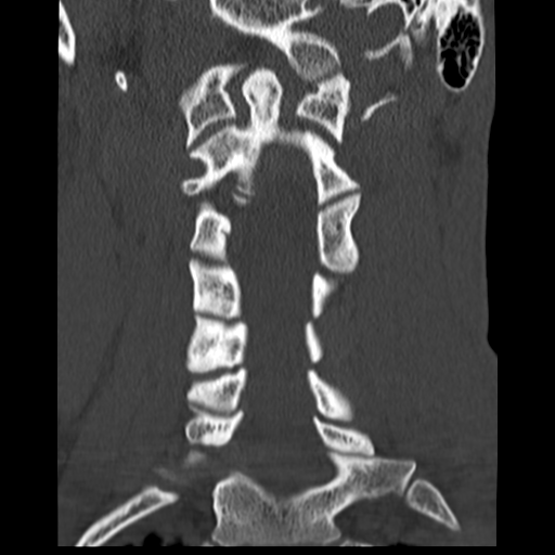File:Normal trauma cervical spine (Radiopaedia 41017-43760 Coronal bone window 20).png