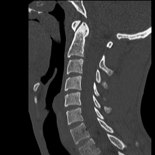 File:Normal trauma cervical spine (Radiopaedia 41017-43760 Sagittal bone window 21).png