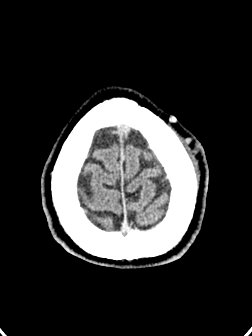 Normal trauma protocol brain and C-spine CT (Radiopaedia 83302-97709 Axial non-contrast 13).jpg