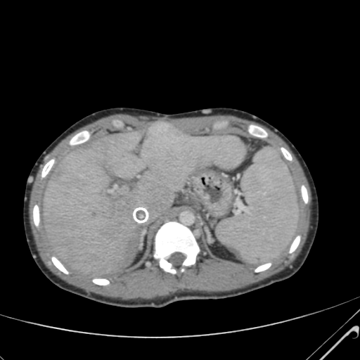 File:Nutmeg liver- Budd-Chiari syndrome (Radiopaedia 46234-50635 B 16).png