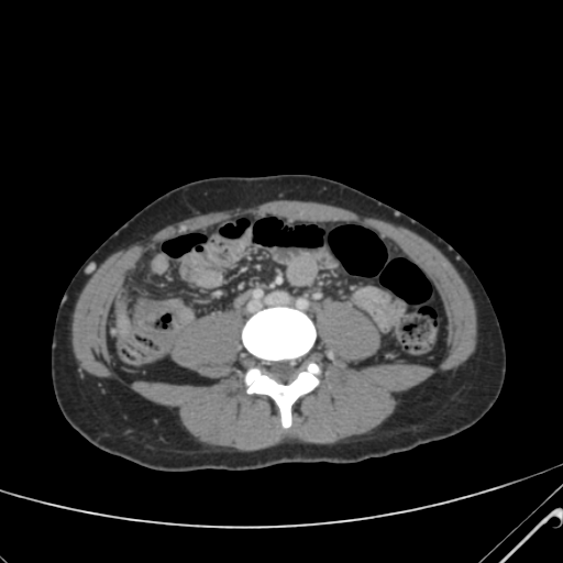 File:Nutmeg liver- Budd-Chiari syndrome (Radiopaedia 46234-50635 B 44).png
