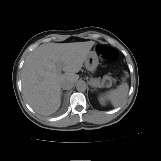 File:Obstructed kidney with perinephric urinoma (Radiopaedia 26889-27066 Axial non-contrast 3).jpg
