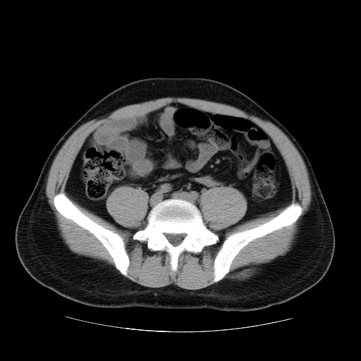 File:Obstructing ureteric calculus (Radiopaedia 18615-18514 Axial non-contrast 37).jpg