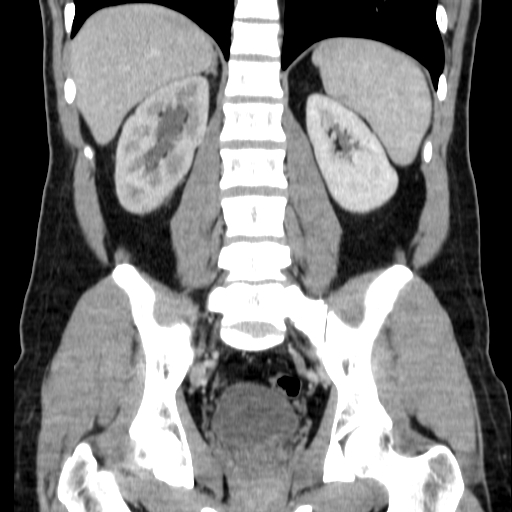 File:Obstructing ureteric calculus (Radiopaedia 18615-18514 C 53).jpg