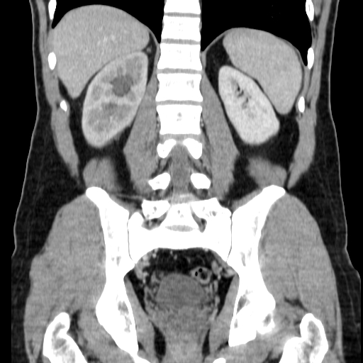 File:Obstructing ureteric calculus (Radiopaedia 18615-18514 C 55).jpg