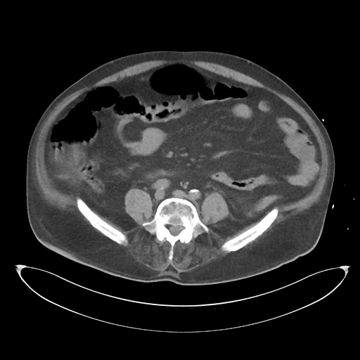 File:Obstructive pyelonephritis (Radiopaedia 46411-50844 Axial non-contrast 49).png