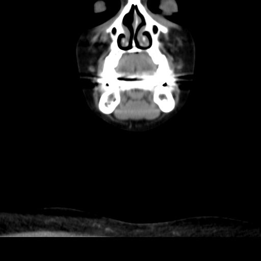 File:Obstructive sleep apnea (CT evaluation) (Radiopaedia 24304-24582 Coronal non-contrast 22).jpg