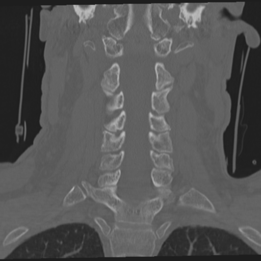 File:Occipital condyle fracture (Radiopaedia 33467-34517 Coronal bone window 35).png