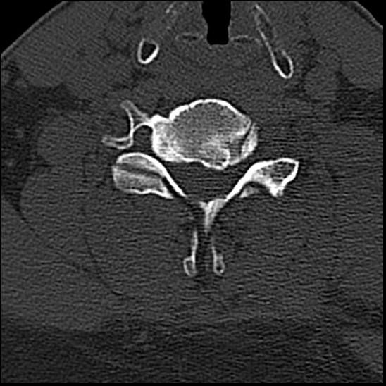 Occipital condyle fracture (type 1) (Radiopaedia 87670-104084 Axial bone window 61).jpg