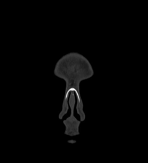 Occipital spur and Currarino type A atlas anomaly (Radiopaedia 87027-103285 Coronal bone window 20).jpg
