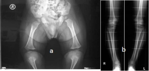 a,b)10 year old with hypochondroplasia (with variable degrees of genu varum)