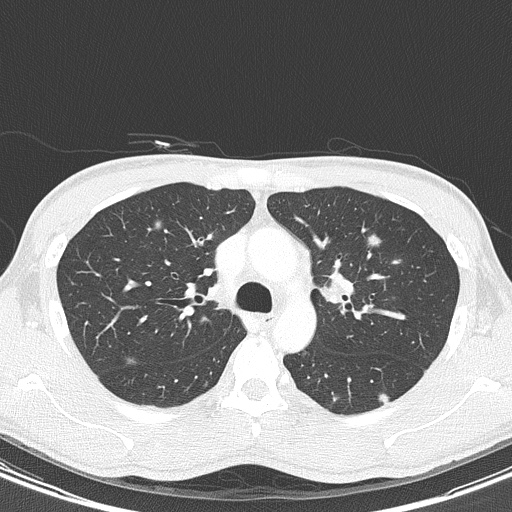 File:AIDS-related Kaposi sarcoma (Radiopaedia 85247-100811 Axial lung window 54).jpg