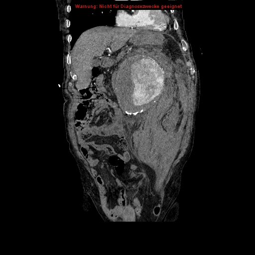 Abdominal aortic aneurysm- extremely large, ruptured (Radiopaedia 19882-19921 Coronal C+ arterial phase 34).jpg