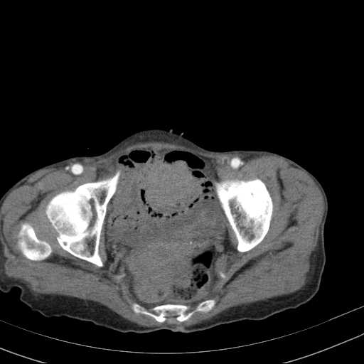 File:Abdominal aortic aneurysm (Radiopaedia 20827-20742 Axial C+ arterial phase 36).jpg