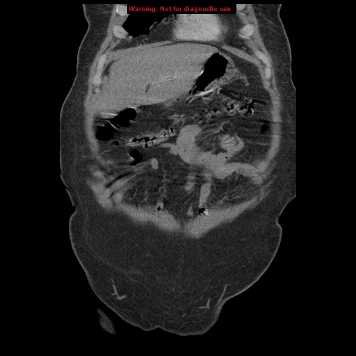 Abdominal aortic aneurysm (Radiopaedia 8190-9038 Coronal C+ arterial phase 22).jpg