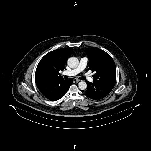 Abdominal aortic aneurysm (Radiopaedia 83094-97462 Axial renal cortical phase 36).jpg