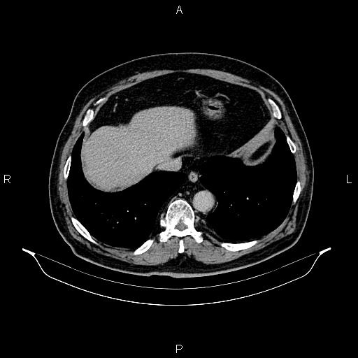 Abdominal aortic aneurysm (Radiopaedia 83094-97462 Axial renal excretory phase 15).jpg