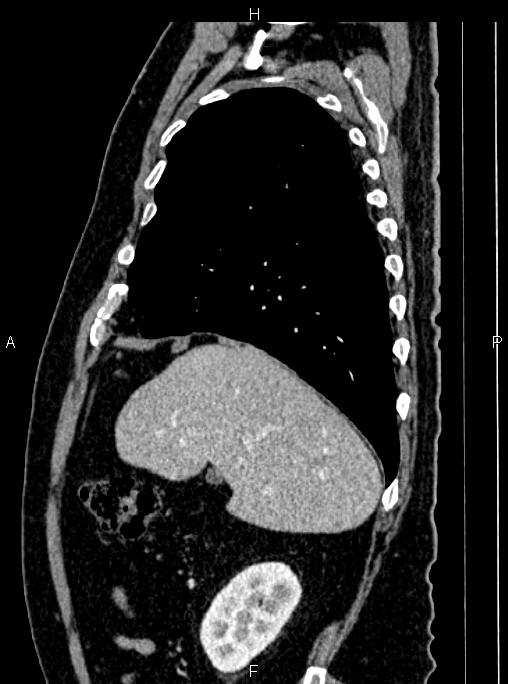 Abdominal aortic aneurysm (Radiopaedia 83094-97462 Sagittal renal cortical phase 34).jpg