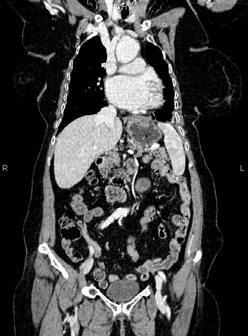 Abdominal aortic aneurysm (Radiopaedia 85063-100606 Coronal C+ arterial phase 21).jpg