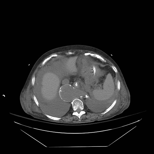 Abdominal aortic aneurysm - impending rupture (Radiopaedia 19233-19247 Axial non-contrast 34).jpg