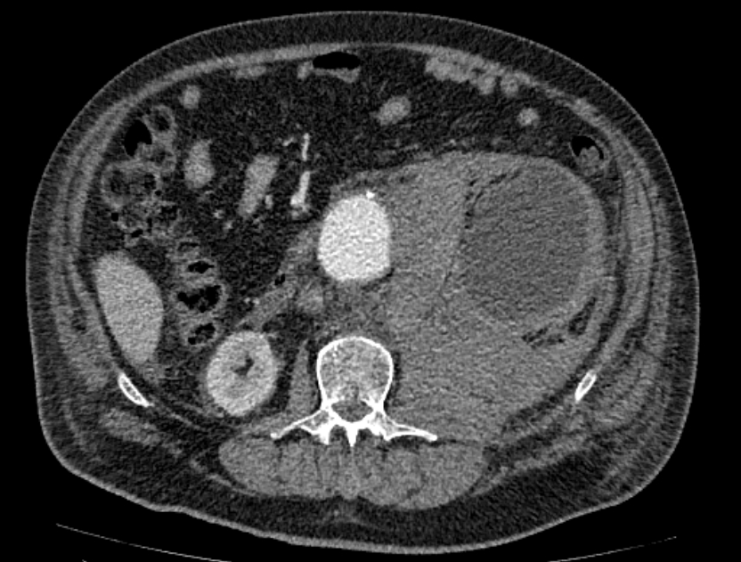 Abdominal aortic aneurysm rupture (Radiopaedia 54179-60362 Axial C+ portal venous phase 21).jpg