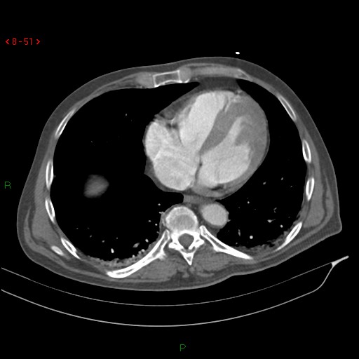 Abdominal aortic aneurysm rupture with aortocaval fistula (Radiopaedia 14897-14841 Axial C+ arterial phase 51).jpg