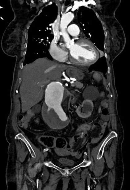 Abdominal aortic aneurysm with thrombus fissuration (Radiopaedia 73192-83919 Coronal C+ arterial phase 30).jpg
