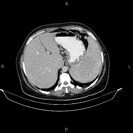 Abdominal lymphoma with sandwich sign (Radiopaedia 84378-99704 Axial C+ portal venous phase 11).jpg