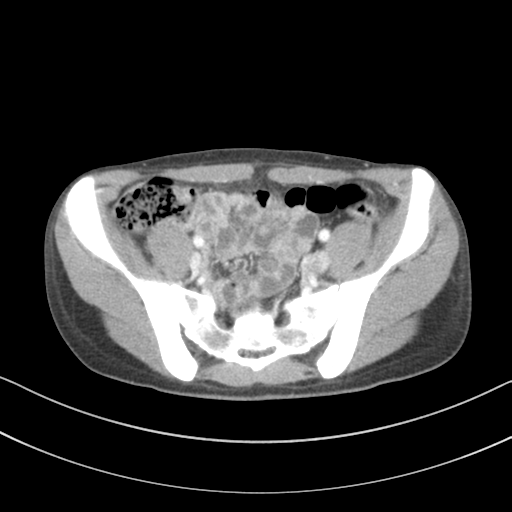 File:Abdominal multi-trauma - devascularised kidney and liver, spleen and pancreatic lacerations (Radiopaedia 34984-36486 Axial C+ portal venous phase 63).png