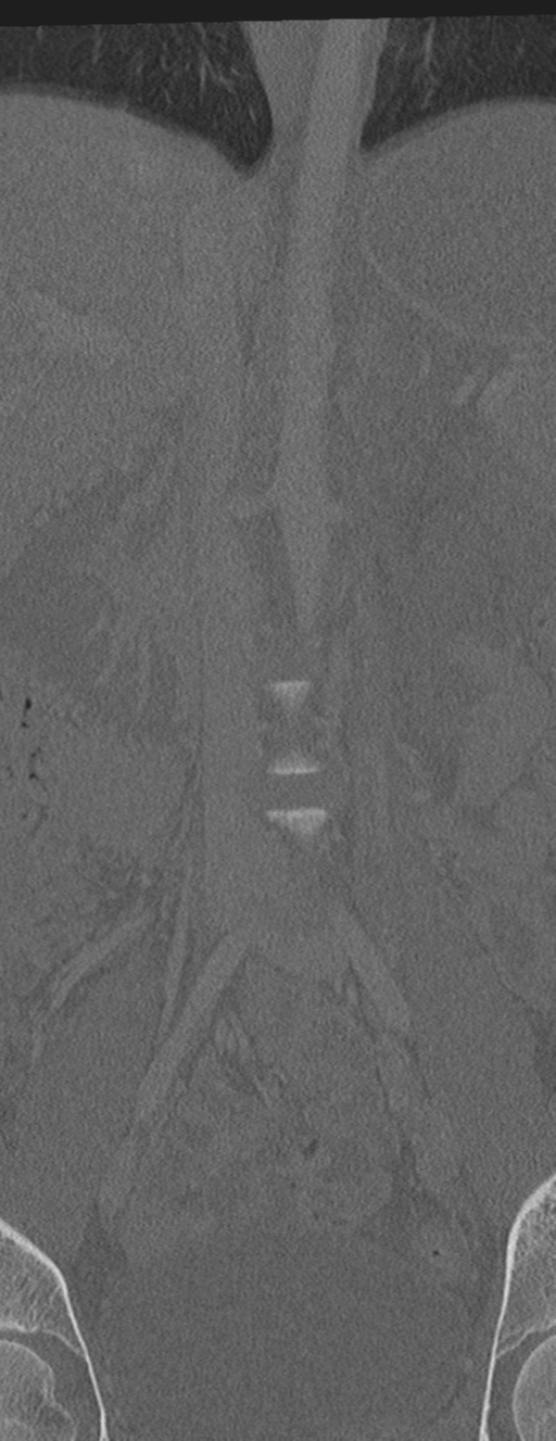 Abdominal multi-trauma - devascularised kidney and liver, spleen and pancreatic lacerations (Radiopaedia 34984-36486 Coronal bone window 13).png