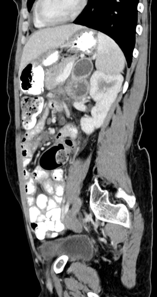 Abdominal wall and retroperitoneal tuberculosis (Radiopaedia 88137-104729 Sagittal C+ portal venous phase 55).jpg
